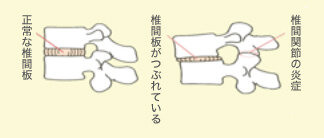 椎間関節に負担がかかり肩こりが生じる