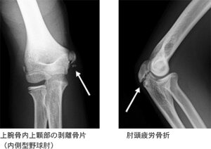 肘・手首の障害